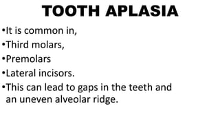 TOOTH APLASIA
•It is common in,
•Third molars,
•Premolars
•Lateral incisors.
•This can lead to gaps in the teeth and
an uneven alveolar ridge.
 