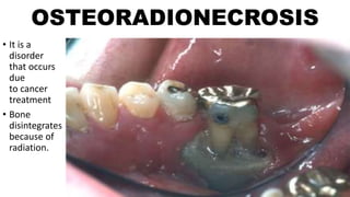 OSTEORADIONECROSIS
• It is a
disorder
that occurs
due
to cancer
treatment
• Bone
disintegrates
because of
radiation.
 