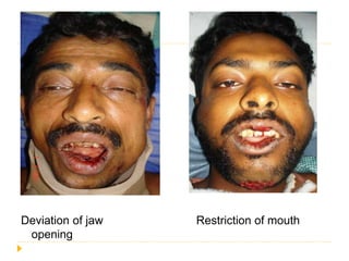 Deviation of jaw Restriction of mouth
opening
 