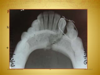 Radiological examination
Ideally need 2 radiographic views of the fracture that are
oriented 90’ from one another to properly work up
fractures
 Single view can lead to misdiagnosis and complications
with treatment
08-03-2017Mandibular Fractures 14
 