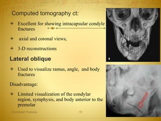Computed tomography ct:
 Excellent for showing intracapsular condyle
fractures
 axial and coronal views,
 3-D reconstructions
Lateral oblique
 Used to visualize ramus, angle, and body
fractures
Disadvantage:
 Limited visualization of the condylar
region, symphysis, and body anterior to the
premolar
08-03-2017Mandibular Fractures 15
 