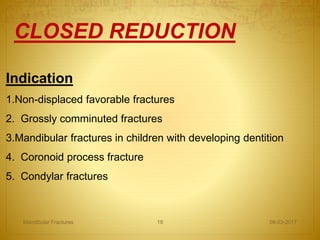 08-03-2017Mandibular Fractures 19
CLOSED REDUCTION
Indication
1.Non-displaced favorable fractures
2. Grossly comminuted fractures
3.Mandibular fractures in children with developing dentition
4. Coronoid process fracture
5. Condylar fractures
 