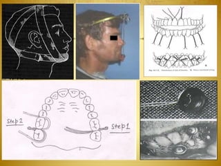08-03-2017Mandibular Fractures 21
 