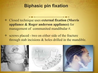 Biphasic pin fixation
 Closed technique uses external fixation (Morris
appliance & Roger anderson appliance) for
management of communited mandibular #.
 screws placed - two on either side of the fracture
through stab incisions & holes drilled in the mandible.
08-03-2017Mandibular Fractures 25
 