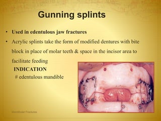 • Used in edentulous jaw fractures
• Acrylic splints take the form of modified dentures with bite
block in place of molar teeth & space in the incisor area to
facilitate feeding
INDICATION
# edentulous mandible
Gunning splints
08-03-2017Mandibular Fractures 26
 