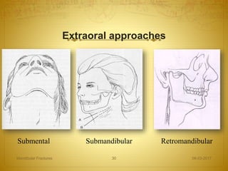 Extraoral approaches
08-03-2017Mandibular Fractures 30
Submental Submandibular Retromandibular
 