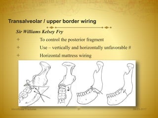 Transalveolar / upper border wiring
Sir Williams Kelsey Fry
 To control the posterior fragment
 Use – vertically and horizontally unfavorable #
 Horizontal mattress wiring
08-03-2017Mandibular Fractures 31
 
