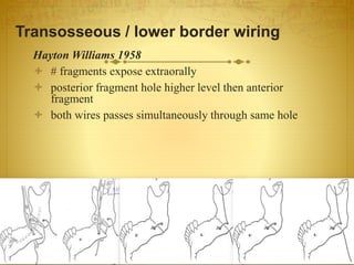 Transosseous / lower border wiring
Hayton Williams 1958
 # fragments expose extraorally
 posterior fragment hole higher level then anterior
fragment
 both wires passes simultaneously through same hole
08-03-2017Mandibular Fractures 32
 
