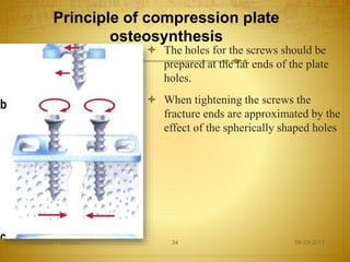 Principle of compression plate
osteosynthesis
 The holes for the screws should be
prepared at the far ends of the plate
holes.
 When tightening the screws the
fracture ends are approximated by the
effect of the spherically shaped holes
08-03-2017Mandibular Fractures 34
 