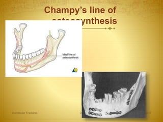 Champy’s line of
osteosynthesis
08-03-2017Mandibular Fractures 37
 