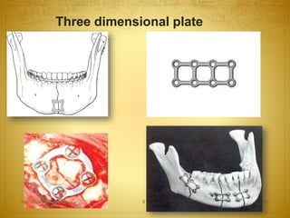 Three dimensional plate
08-03-2017Mandibular Fractures 41
 