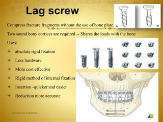 Lag screw
Compress fracture fragments without the use of bone plate
Two sound bony cortices are required -- Shares the loads with the bone
Uses:
 absolute rigid fixation
 Less hardware
 More cost effective
 Rigid method of internal fixation
 Insertion -quicker and easier
 Reduction more accurate
08-03-2017Mandibular Fractures 43
 