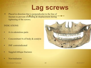 Lag screws
 Placed in direction that is perpendicular to the line of
fracture to prevent overriding & displacement during
tightening of the screws.
INDICATIONS
• #s in edentulous parts
• Concomittant #s of body & condyle
• IMF contraindicated
• Saggital/oblique fractures
• Non/malunion
08-03-2017Mandibular Fractures 44
 