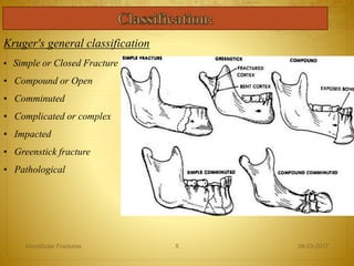 Kruger's general classification
• Simple or Closed Fracture
• Compound or Open
• Comminuted
• Complicated or complex
• Impacted
• Greenstick fracture
• Pathological
08-03-2017Mandibular Fractures 5
 