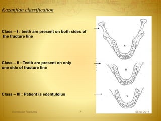 Kazanjian classification
Class – III : Patient is edentulolus
Class – I : teeth are present on both sides of
the fracture line
Class – II : Teeth are present on only
one side of fracture line
08-03-2017Mandibular Fractures 7
 
