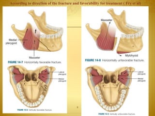 08-03-2017Mandibular Fractures 8
According to direction of the fracture and favorability for treatment ( Fry et al)
 