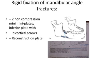 Mandible fracture | PPTX