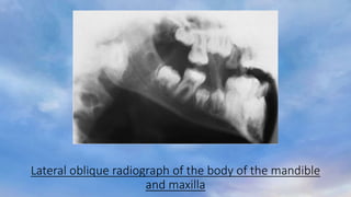 Lateral oblique radiograph of the body of the mandible
and maxilla
 