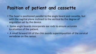 Cassette and the X-ray tube positions for a right lateral oblique
radiograph of the ramus of the mandible
 