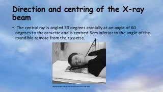 Direction and centring of the X-ray
beam
• The central ray is angled 30 degrees cranially at an angle of 60
degrees to the cassette and is centred 5cm inferior to the angle of the
mandible remote from the cassette.
30 °
Patient lying supine on the X-ray couch and positioned for a right lateral
 