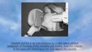 Cassette and the X-ray tube positions for a right lateral oblique
radiograph of the body of the mandible and maxilla. Note the rotation
of the head with flattening of the nose against the cassette
 