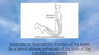 Schematic to illustrate the direction of the beam
for a lateral oblique radiograph of the body of the
mandible and maxilla
 