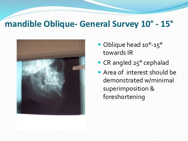 Mandible and maxilla oblique radiography