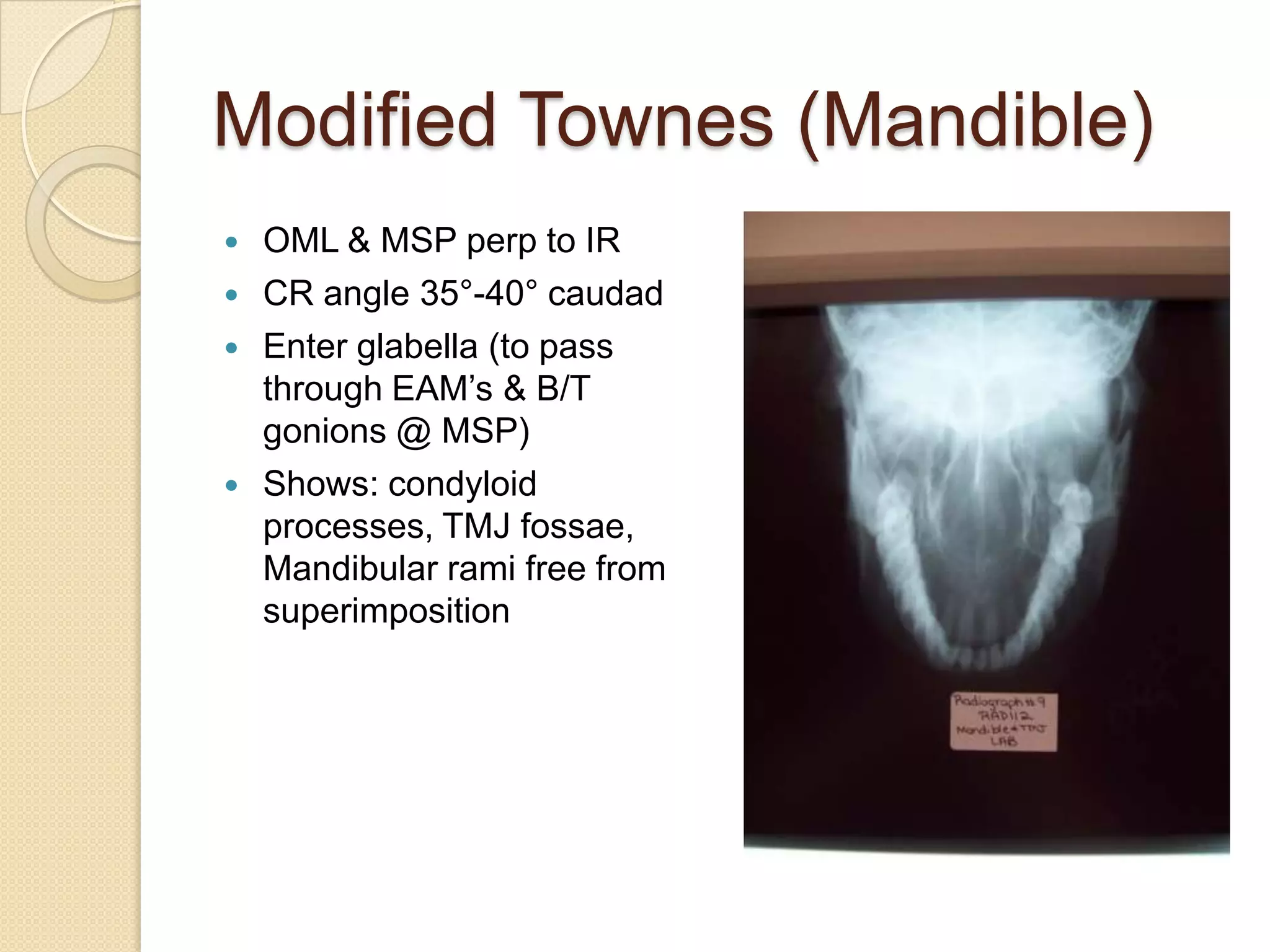 Mandible, T M J