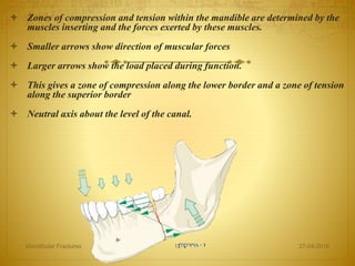  Zones of compression and tension within the mandible are determined by the
muscles inserting and the forces exerted by these muscles.
 Smaller arrows show direction of muscular forces
 Larger arrows show the load placed during function.
 This gives a zone of compression along the lower border and a zone of tension
along the superior border
 Neutral axis about the level of the canal.
27-04-2016Mandibular Fractures 12
 