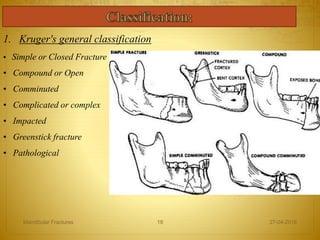1. Kruger's general classification
• Simple or Closed Fracture
• Compound or Open
• Comminuted
• Complicated or complex
• Impacted
• Greenstick fracture
• Pathological
27-04-2016Mandibular Fractures 19
 