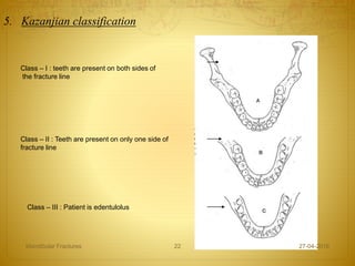 5. Kazanjian classification
Class – III : Patient is edentulolus
Class – I : teeth are present on both sides of
the fracture line
Class – II : Teeth are present on only one side of
fracture line
27-04-2016Mandibular Fractures 22
 