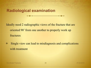 Radiological examination
Ideally need 2 radiographic views of the fracture that are
oriented 90’ from one another to properly work up
fractures
 Single view can lead to misdiagnosis and complications
with treatment
27-04-2016Mandibular Fractures 39
 
