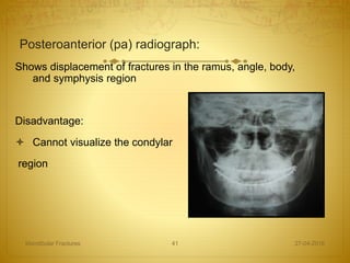 Posteroanterior (pa) radiograph:
Shows displacement of fractures in the ramus, angle, body,
and symphysis region
Disadvantage:
 Cannot visualize the condylar
region
27-04-2016Mandibular Fractures 41
 