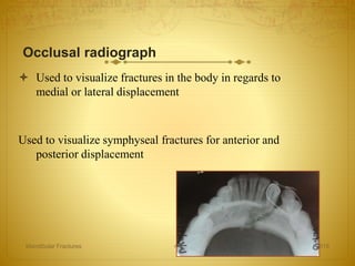 Occlusal radiograph
 Used to visualize fractures in the body in regards to
medial or lateral displacement
Used to visualize symphyseal fractures for anterior and
posterior displacement
27-04-2016Mandibular Fractures 43
 