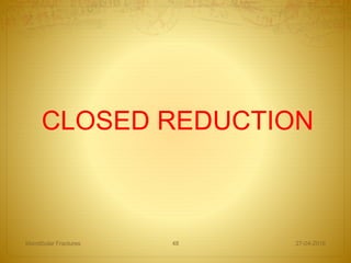 27-04-2016Mandibular Fractures 48
CLOSED REDUCTION
 