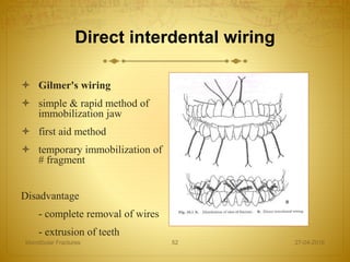 Direct interdental wiring
 Gilmer's wiring
 simple & rapid method of
immobilization jaw
 first aid method
 temporary immobilization of
# fragment
Disadvantage
- complete removal of wires
- extrusion of teeth
27-04-2016Mandibular Fractures 52
 
