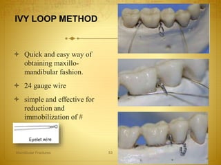 IVY LOOP METHOD
 Quick and easy way of
obtaining maxillo-
mandibular fashion.
 24 gauge wire
 simple and effective for
reduction and
immobilization of #
27-04-2016Mandibular Fractures 53
 