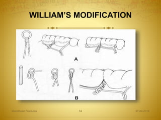 WILLIAM’S MODIFICATION
27-04-2016Mandibular Fractures 54
 