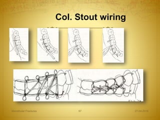 Col. Stout wiring
27-04-2016Mandibular Fractures 57
 