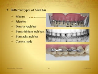  Different types of Arch bar
 Winters
 Jelenkos
 Dautrys Arch bar
 Berns titinium arch bars
 Burmachs arch bar
 Custom made
27-04-2016Mandibular Fractures 60
 