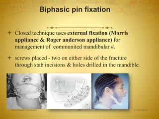 Biphasic pin fixation
 Closed technique uses external fixation (Morris
appliance & Roger anderson appliance) for
management of communited mandibular #.
 screws placed - two on either side of the fracture
through stab incisions & holes drilled in the mandible.
27-04-2016Mandibular Fractures 64
 