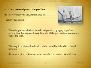  Once external pins are in position,
the fracture segments are manipulated to
achieve reduction.
 Then the pins are locked in reduced position by applying of an
acrylic mix that is placed over the ends of the pins that are protruding
out of the skin.
 The acrylic is allowed to harden while mandible is held in reduced
position.
 Steinmann pins or Kirshner wires can also be used as external pins
27-04-2016Mandibular Fractures 65
 