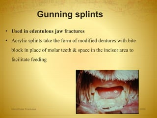 • Used in edentulous jaw fractures
• Acrylic splints take the form of modified dentures with bite
block in place of molar teeth & space in the incisor area to
facilitate feeding
Gunning splints
27-04-2016Mandibular Fractures 68
 