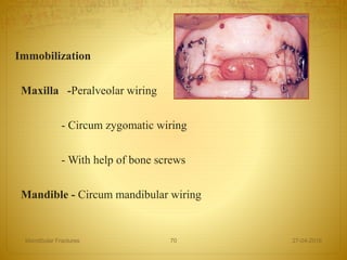 Immobilization
Maxilla -Peralveolar wiring
- Circum zygomatic wiring
- With help of bone screws
Mandible - Circum mandibular wiring
27-04-2016Mandibular Fractures 70
 