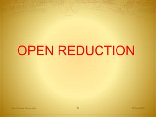 27-04-2016Mandibular Fractures 71
OPEN REDUCTION
 