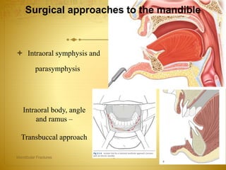 Surgical approaches to the mandible
 Intraoral symphysis and
parasymphysis
27-04-2016Mandibular Fractures 75
Intraoral body, angle
and ramus –
Transbuccal approach
 