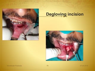 Degloving incision
27-04-2016Mandibular Fractures 76
 
