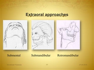 Extraoral approaches
27-04-2016Mandibular Fractures 77
Submental Submandibular Retromandibular
 