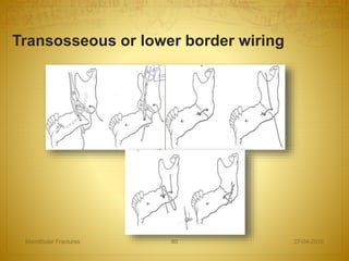 Transosseous or lower border wiring
27-04-2016Mandibular Fractures 80
 