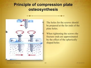 Principle of compression plate
osteosynthesis
 The holes for the screws should
be prepared at the far ends of the
plate holes.
 When tightening the screws the
fracture ends are approximated
by the effect of the spherically
shaped holes
27-04-2016Mandibular Fractures 83
 